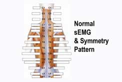 Normal Surface Electromyography Scan & Symmetry Pattern